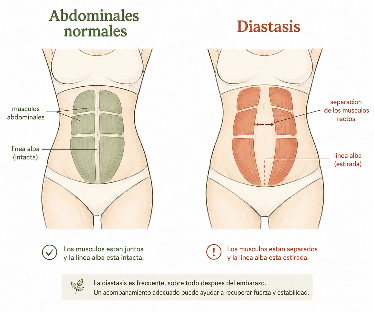 Esquema diástasis